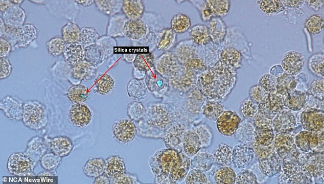 Zellen aus der Lunge eines Patienten mit Silikose – beachten Sie den hell leuchtenden Quarzstaubfleck