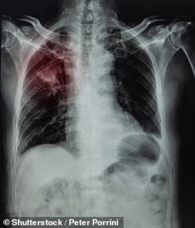 Bei der Silikose bildet sich Quarzstaub, der langsam die Lunge vernarbt.  Die Krankheit betrifft typischerweise Handwerker