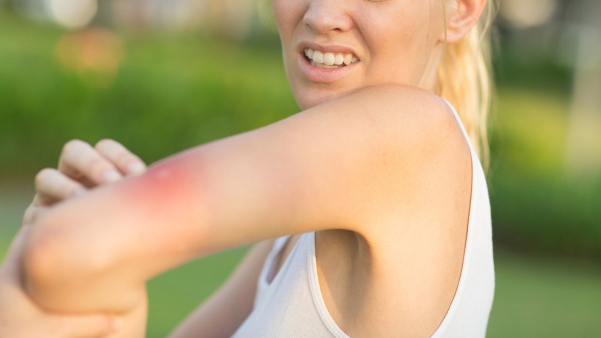 Frau kratzt sich an einem Mückenstich