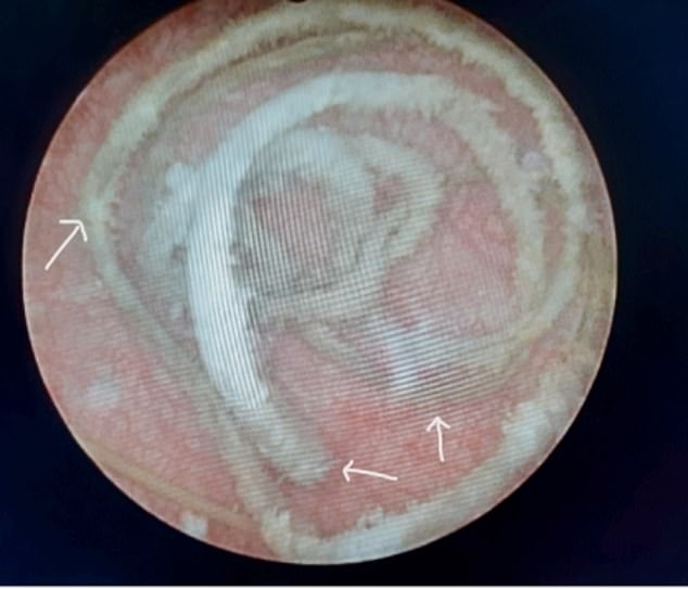 Das Foto zeigt den langen, spiralförmigen Draht, der in der Blase des Patienten gefunden wurde.  Es war mit Ablagerungen von Kalziumsalzen verkrustet