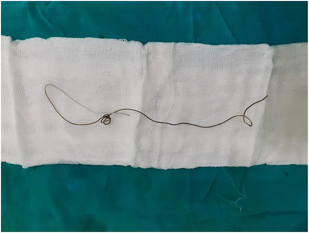 Das Foto oben zeigt den Fremdkörper, einen zwanzig Zentimeter langen Draht, der aus dem Körper des Patienten entnommen wurde