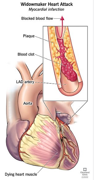 Das obige Bild zeigt, was bei einem Witwenmacher-Herzinfarkt passiert, der durch eine Blockade der linken Hauptkoronararterie (LMCA) verursacht wird.
