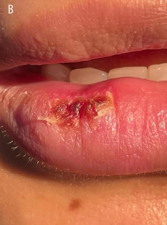 Oben abgebildet sind die Lippen der 26-jährigen Frau nach der Operation.  Eine Woche nach dem Eingriff kam sie zur Kontrolle