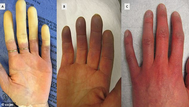 Beim ersten Auftreten der Raynaud-Symptome werden die Finger weiß, da die Durchblutung eingeschränkt ist.  Wenn das Gewebe Sauerstoff verliert, verfärben sich die Finger bläulich.  Wenn die Durchblutung zurückkehrt, werden die Finger rot und es kann zu Kribbeln, Schwellungen und/oder schmerzhaftem Pochen kommen
