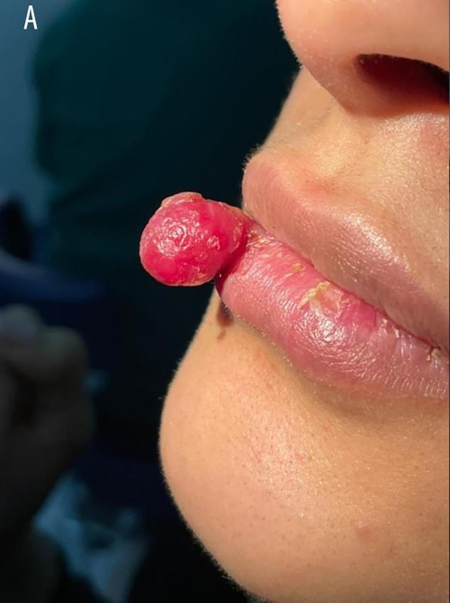 Eine 26-jährige Frau aus Saudi-Arabien litt unter der oben genannten Wucherung, nachdem sie sich eine Verletzung an den Lippen zugezogen hatte.  Sie war zu diesem Zeitpunkt schwanger