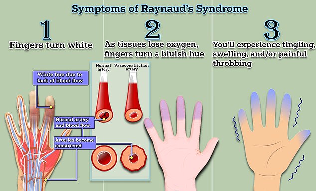 Die Raynaud-Krankheit, von der schätzungsweise zwei bis fünf Prozent der Menschen betroffen sind, verursacht kleine Krämpfe in den Blutgefäßen, die die Blutversorgung der Finger und Zehen unterbrechen