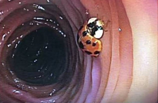 Ärzte fanden während einer regelmäßigen Vorsorgekoloskopie einen vollständig intakten Marienkäfer im Dickdarm eines Mannes aus Missouri