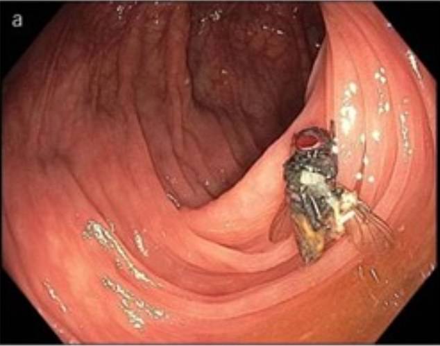 Das obige Bild, dessen Veröffentlichung der Patient gestattet hat, zeigt die Fliege, wie sie in seinem Darm gefunden wurde.  Es bewegte sich nicht, als es angestoßen wurde