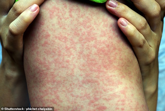 Die Paramyxovirus-Familie umfasst über 75 Viren, darunter Mumps, Masern und Atemwegsinfektionen.  Masern verursachen schreckliche Hautausschläge (im Bild)