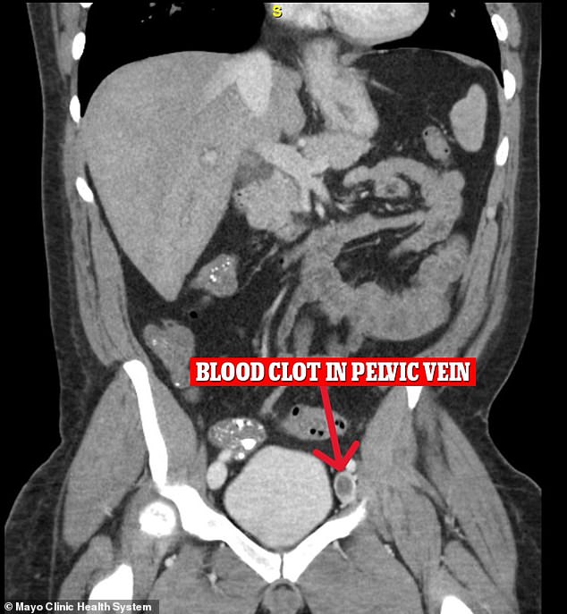 Ein zusätzlicher CT-Scan des Beckens des Mannes ergab außerdem eine tiefe Venenthrombose (TVT), ein Blutgerinnsel, das sich aus einer tiefen Vene im Bein oder Becken gelöst hat, bevor es in die Lunge gelangt