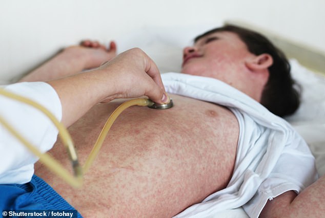 Experten sind so besorgt, dass sie neue Richtlinien für NHS-Mitarbeiter im Umgang mit Kindern mit Atemwegsinfektionen erstellt haben und sie dazu drängen, „an Masern zu denken“.