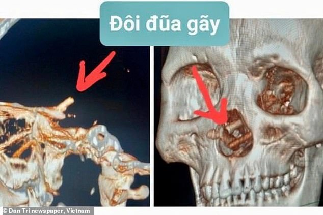 Der CT-Scan des Schädels des 35-jährigen Mannes zeigt, dass Stäbchen aus seiner Nase ragen.  Die eingeklemmten Essstäbchen verursachten bei ihm starke Kopfschmerzen und Flüssigkeitsausfluss