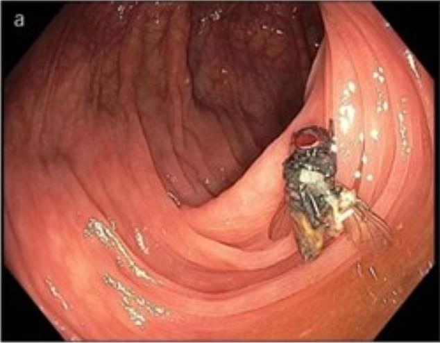 Das obige Bild, dessen Veröffentlichung der Patient gestattet hat, zeigt die Fliege, wie sie in seinem Darm gefunden wurde.  Es bewegte sich nicht, als es angestoßen wurde