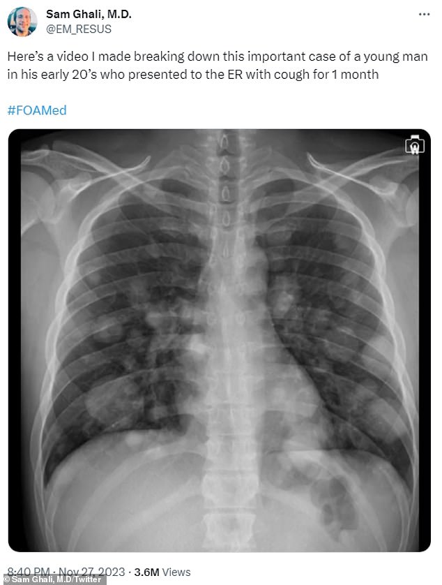 Dr. Sam Ghali, ein in Florida ansässiger Notarzt, besprach den Fall eines jungen Mannes in seinen Zwanzigern, der erst zu spät erkannte, dass er an fortgeschrittenem Hodenkrebs litt, der sich in der Bildung von Krebszellknötchen in der Lunge äußerte geformt wie Kanonenkugeln