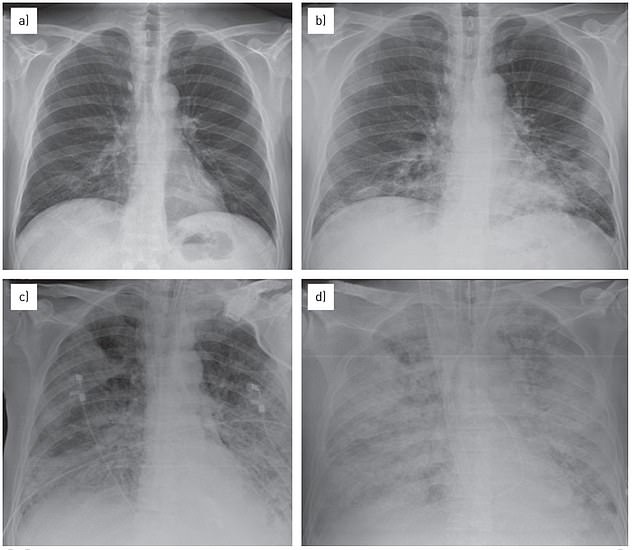 Das obige Bild zeigt die Lunge während des „White-Lung-Syndroms“ oder akuten Atemnotsyndroms, das anhand der weißen Flecken oder undurchsichtigen Bereiche in der Lunge diagnostiziert wird.  Bei dem oben genannten Patienten handelte es sich im Jahr 2014 um einen 57-jährigen Mann