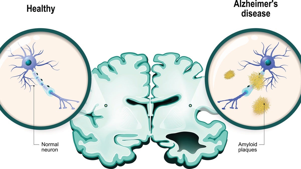 Alzheimer-Gehirn