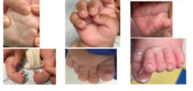 Mehrere Babys hatten verbundene Zehen und abgerundete „Schaukelfüße“.
