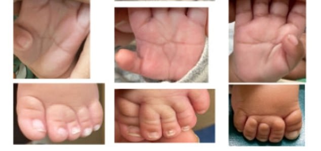 Einige der Babys hatten auch breitere Daumen als üblich und eine einzige horizontale Falte auf ihren Handflächen, im Gegensatz zu den normalen zwei