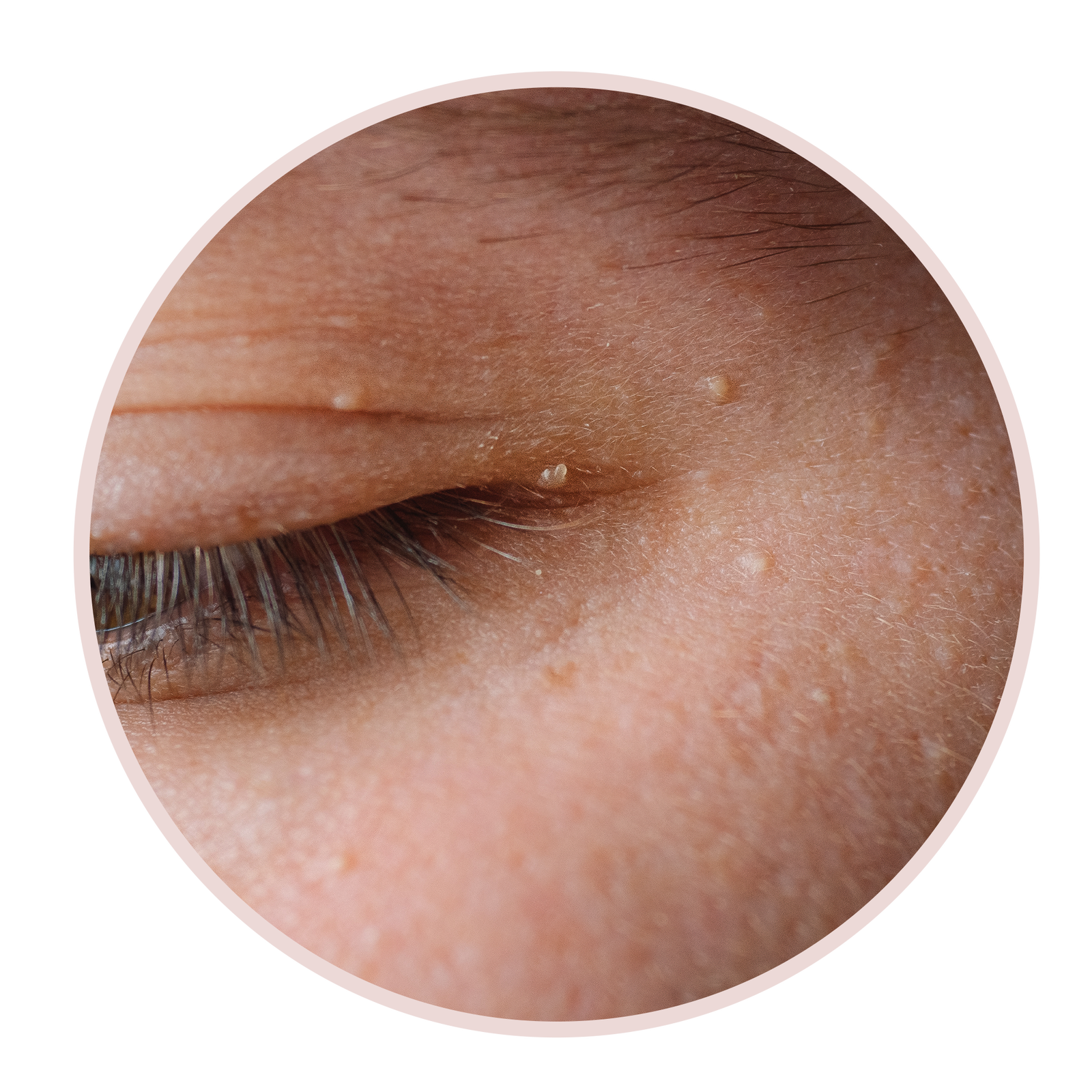 6 Arten von Augenlidbeulen und wie man sie laut Dermatologen behandelt