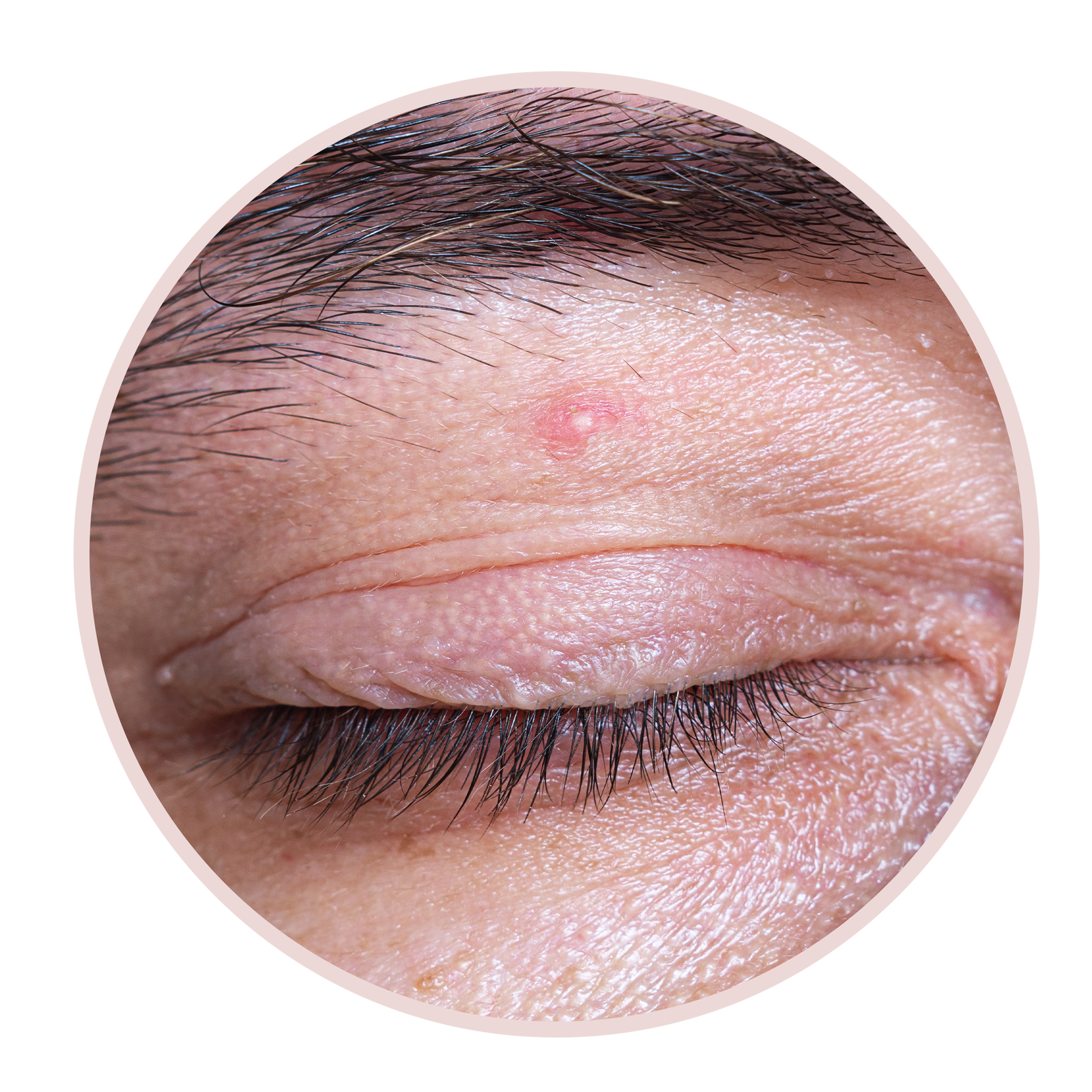 6 Arten von Augenlidbeulen und wie man sie laut Dermatologen behandelt