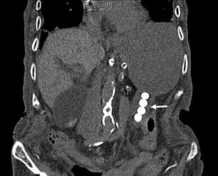 Ein CT-Scan des Mannes zeigte vier ganze Pfefferminzbonbons in seinem Magen