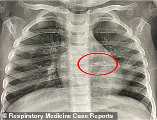 Eine Röntgenaufnahme des Brustkorbs des Mädchens zeigte das Weihnachtslicht in ihrer linken Lunge