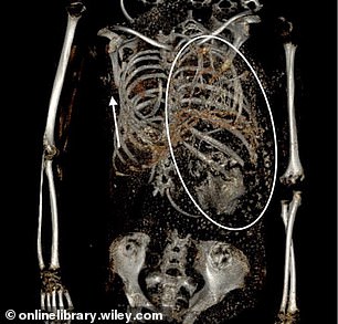 Die Scans der Mumie zeigten, dass ein weiterer Fötus in der Brusthöhle steckte