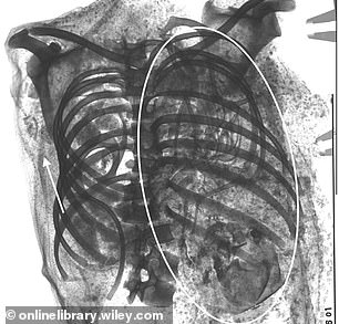 Die CT-Scans identifizierten das Baby in der oberen linken Brusthöhle der Mumie und zeigten lange Knochen, Rippen, Nervenbögen, Schädel und fünf Handknochen