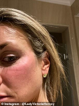 Das ehemalige It-Girl konnte „nicht länger schweigen“ und postete im Dezember Fotos von Isabellas Verletzungen auf Instagram (im Bild: Isabella mit einem blauen Fleck)