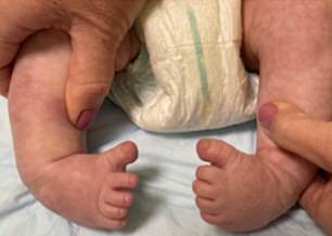 Mehrere Babys hatten „Schaukelfüße“, die sich durch ein gebogenes Aussehen auszeichneten, ähnlich denen, die einem Schaukelstuhl sein Markenzeichen verleihen