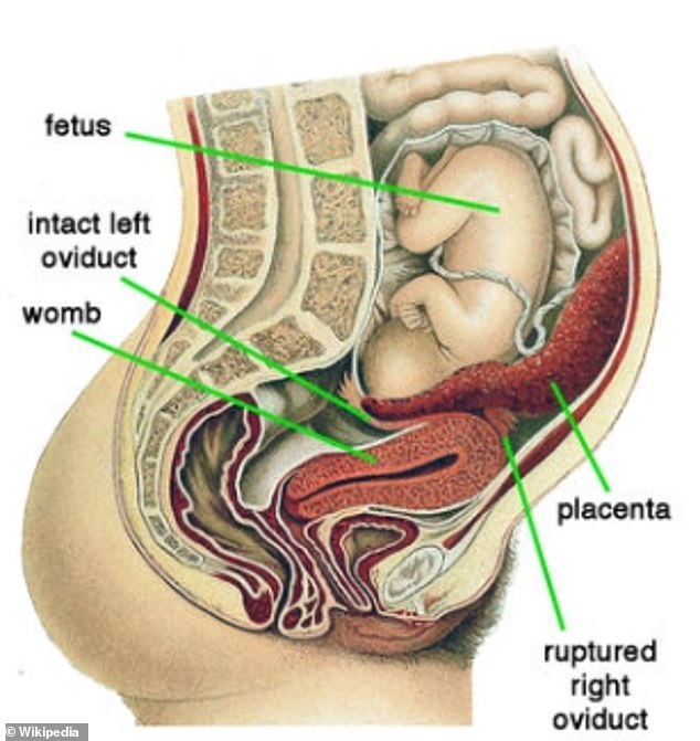 Das Obige zeigt eine Bauchschwangerschaft, die bei der Frau diagnostiziert wurde.  Es zeigt die leere Gebärmutter, in der das Baby stattdessen in der Bauchhöhle wächst.  Ärzte sagen, dass dies passieren kann, wenn ein Baby im Eileiter zu wachsen beginnt, der dann reißt und es dem Fötus ermöglicht, in die Höhle zu „entkommen“.