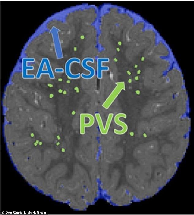 Das Obige zeigt einen Scan des Gehirns eines 24 Monate alten Probanden mit markierter Liquor cerebrospinalis (blau) und perivaskulärem Raum (grün).