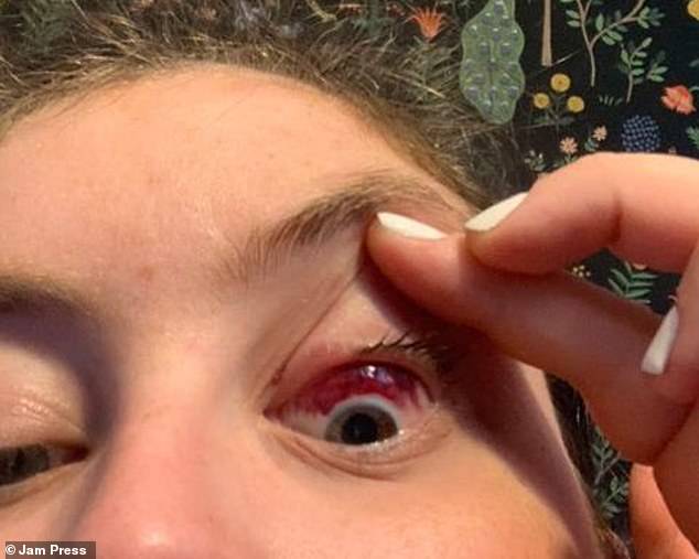 Von einem Augenmelanom sind nur fünf bis sechs von einer Million Amerikaner betroffen.  Es entsteht aus Melanozyten, die der Haut und den Augen Farbe verleihen
