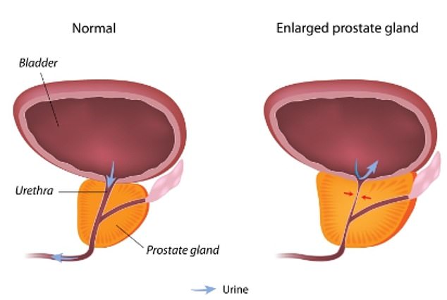 Dieses NHS-Diagramm zeigt, wie eine vergrößerte Prostata beginnen kann, auf die Blase zu drücken und die Harnröhre zu verengen – ein Prozess, der verschiedene Harnprobleme verursachen kann