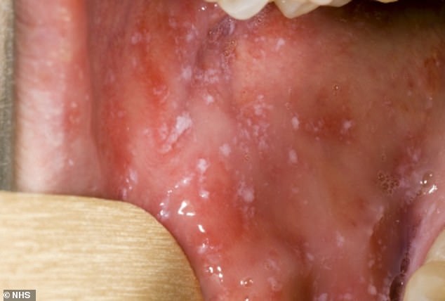 Weiße Flecken im Mund treten häufig auch einige Tage nach den ersten Symptomen auf.  Diese dauern ein paar Tage