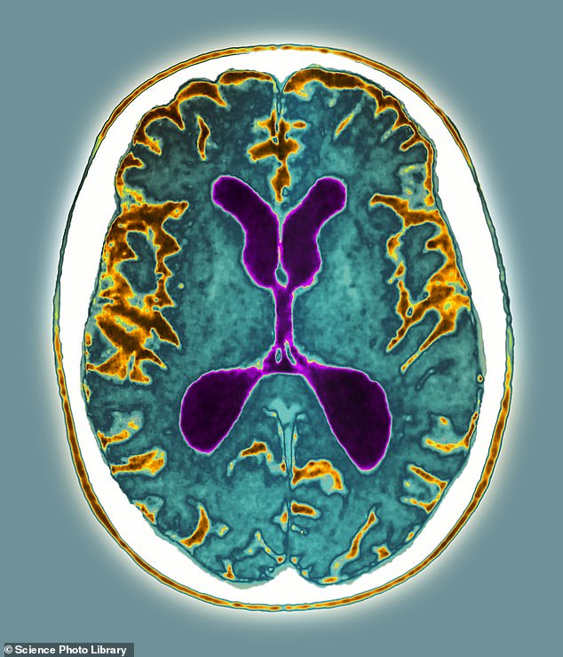 Die Alzheimer-Krankheit, die in Großbritannien die häufigste Ursache für Demenz ist, führt zu einer Degeneration des Gehirns – wie in den braunen Bereichen im Bild oben