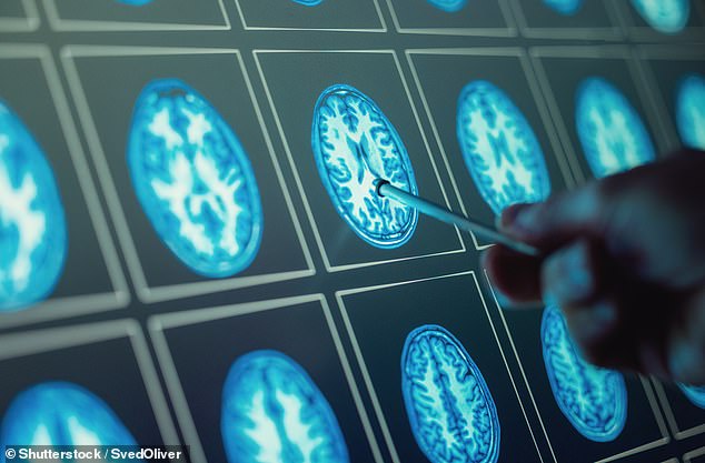 Versuche des Brain Tumor Research Centre of Excellence, Teil des Imperial College London, ergaben, dass sie Spuren der Krankheit in Standardblutproben identifizieren konnten (Stockbild)