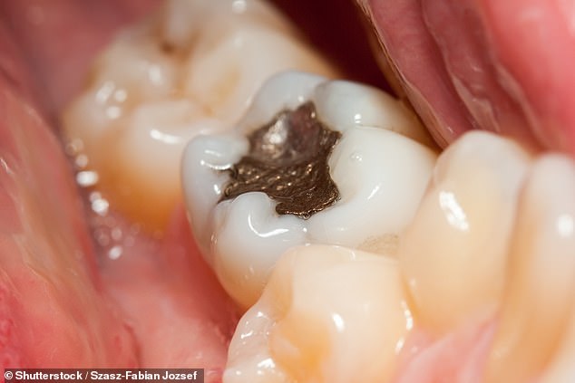 Das Europäische Parlament will Zahnamalgam, das in gewöhnlichen Silberfüllungen verwendet wird, verbieten, da es Angst vor seiner Toxizität hat