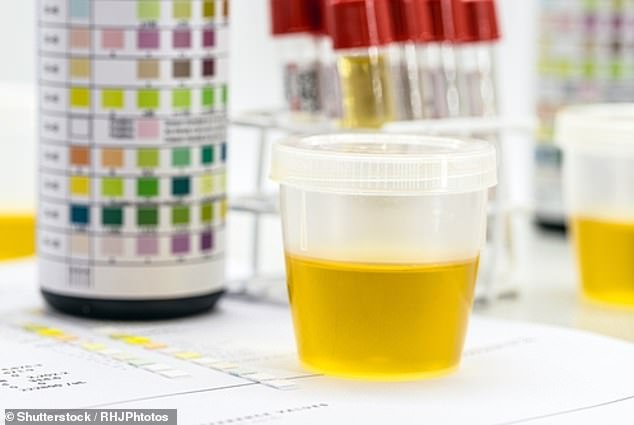 Urobilin verleiht dem Urin seine klassische Farbe.  Ärzte wissen das schon seit langem, aber sie wussten nicht, welches Enzym für die Bildung von Urobilin verantwortlich ist