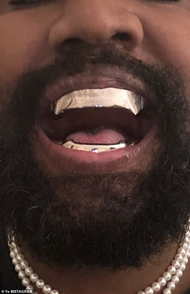 Kanye West hat behauptet, ihm seien bei seinem jüngsten Schockzug alle Zähne entfernt und durch Titanprothesen ersetzt worden