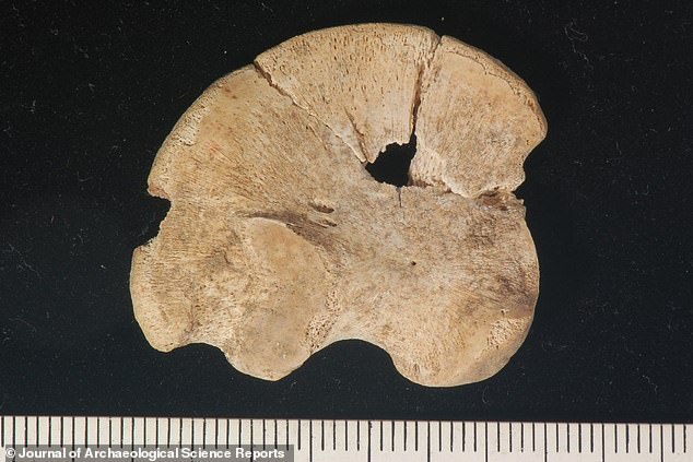 Abgebildet ist das unverwachsene Ilium (einer der drei knöchernen Bestandteile des Hüftknochens) des Neugeborenen aus Grab I