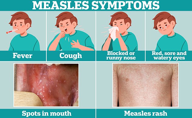 Erkältungsähnliche Symptome wie Fieber, Husten und eine laufende oder verstopfte Nase sind meist die ersten Anzeichen einer Masernerkrankung