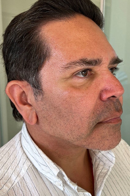 Ein Bild des Gesichts eines Mannes nach einem Facelift