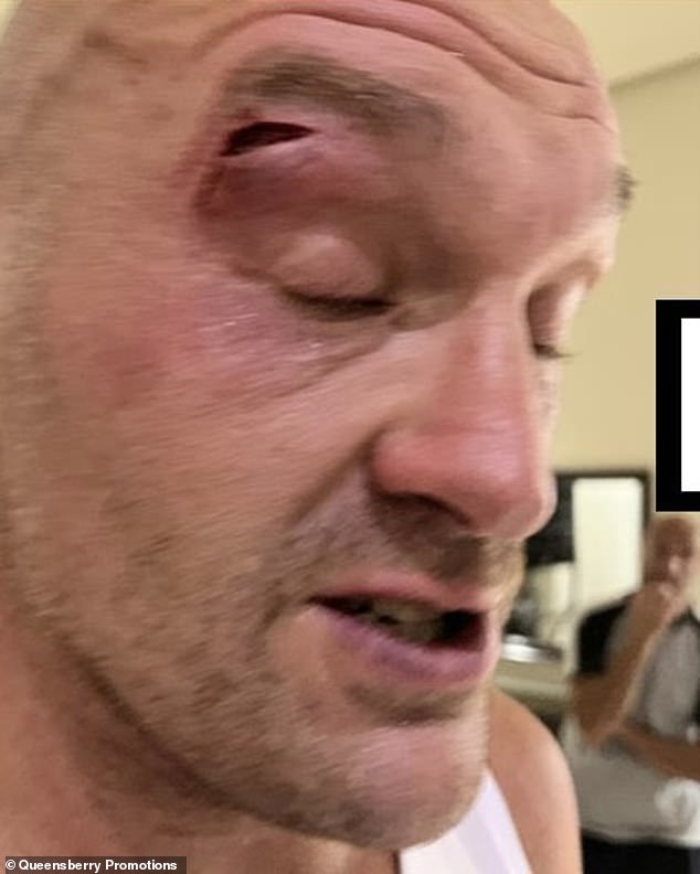Dies ist die böse Platzwunde über Tyson Furys rechtem Auge, die seinen nächsten Kampf verschoben hat