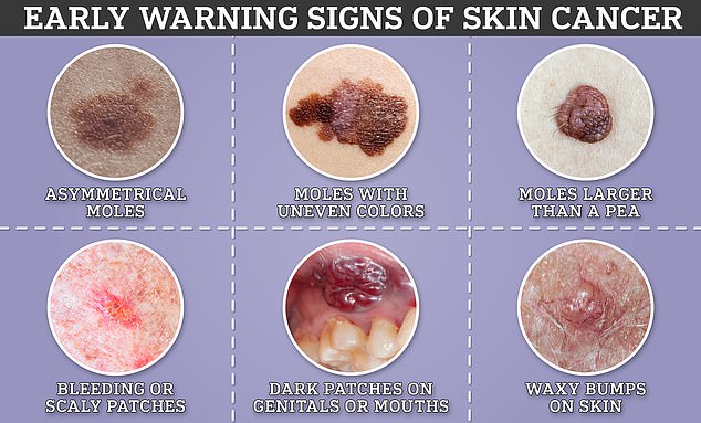 Die Anzeichen von Hautkrebs reichen von harmlos bis offensichtlich. Experten warnen jedoch, dass eine frühzeitige Behandlung von entscheidender Bedeutung ist, um sicherzustellen, dass er sich nicht ausbreitet oder sich weiterentwickelt