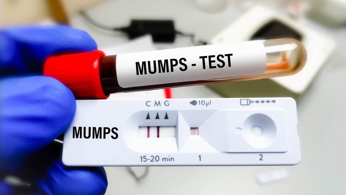 Mumps-Test