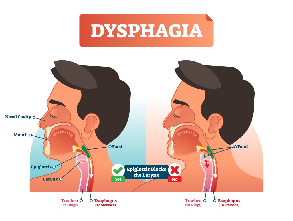 Gezeigt wird die Dysphagie, eines der Symptome, die bei Menschen mit Demenz auftreten können.