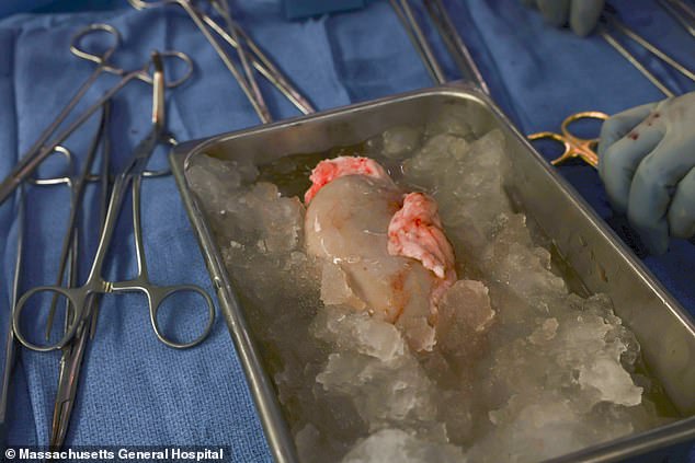 Dieses vom Mass General Hospital zur Verfügung gestellte Bild zeigt die genetisch veränderte Schweineniere, die vor der Implantation auf Eis liegt