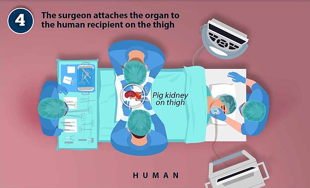 Der Chirurg befestigt das Organ am menschlichen Empfänger am Oberschenkel