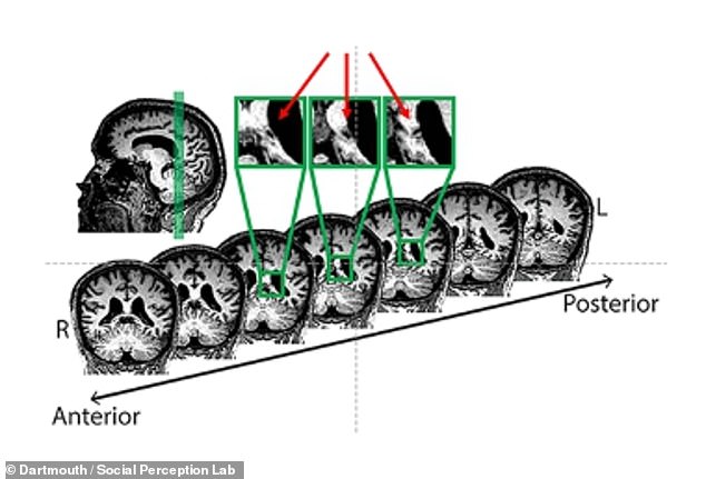 Schäden, die zu PMO führten, wurden häufig in Form von Läsionen am Hinterhaupts- und Schläfenlappen im hinteren Teil des Gehirns gefunden, in der Nähe von Bereichen, die Neurowissenschaftler als Gesichtserkennungsbereiche klassifiziert haben (oben grün markiert).  Aber einige mysteriöse Fälle sind schwieriger aufzuspüren